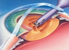Cataract Surgery Step 2