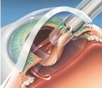 Cataract Surgery Step 3