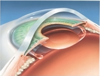 Cataract Surgery Step 4