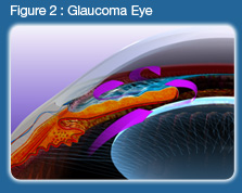 Glaucoma Figure 2
