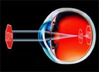 Myopia or Nearsightedness